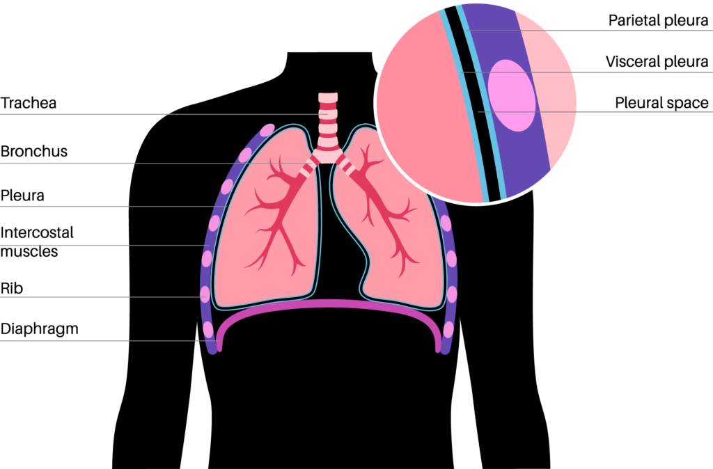 mesothelioma on lung lining